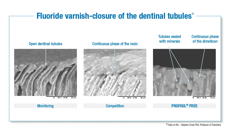 Fluoride varnish-closure of the dentinal tubules